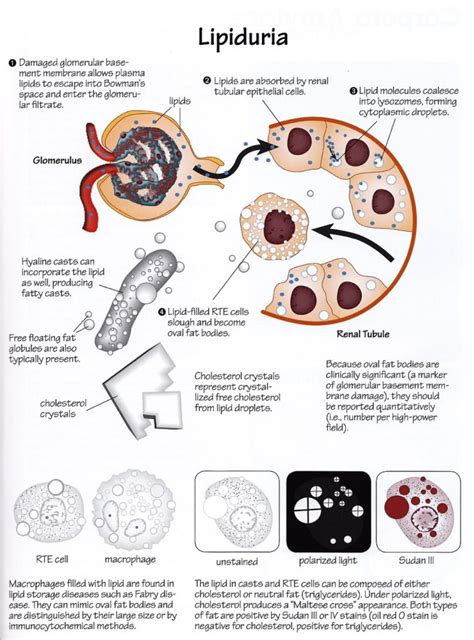 Urine Sediment of the Month: All About Those Oval Fat Bodies - Renal ...