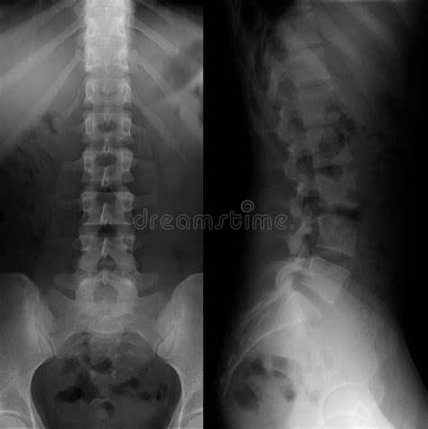 X-ray of the Lumbosacral Spine. Normal. Perfect Stock Photo - Image of clinic, medicine: 137206852