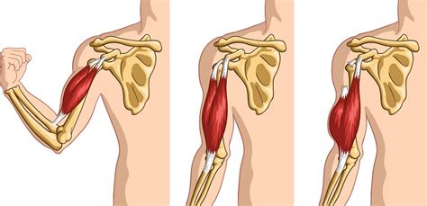 What Causes a Bicep to Tear: How to Prevent and Treatment Options ...