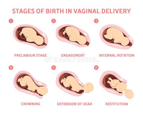 Stages of Baby Birth in Vaginal Delivery Stock Vector - Illustration of ...