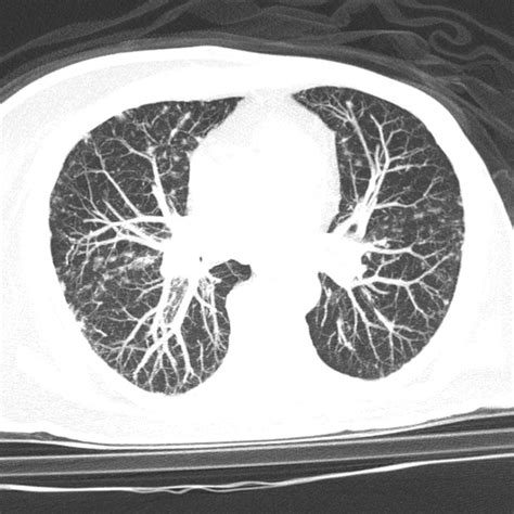 hepatopulmonary syndrome