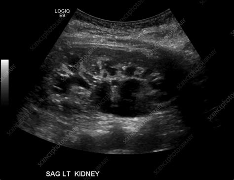 Hydronephrosis, ultrasound - Stock Image - C039/3878 - Science Photo ...