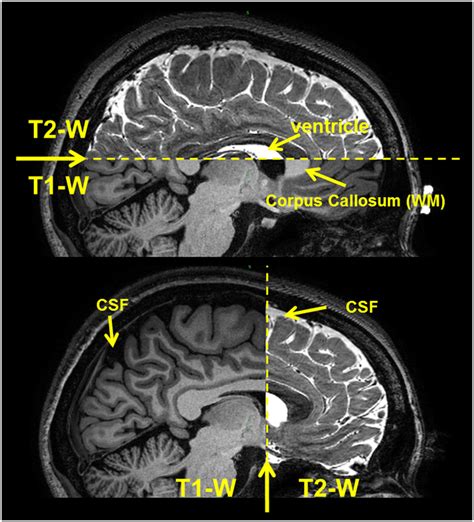 T1 And T2 MRI Signals Images, Photos | Mungfali