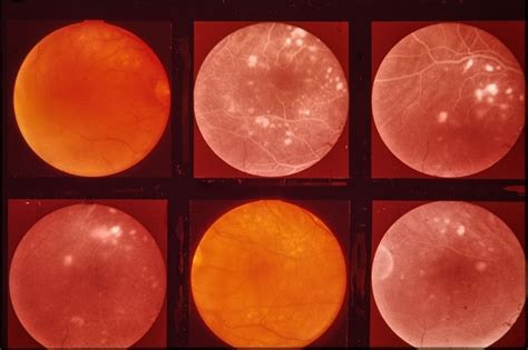 Central Serous Retinopathy - Retina Image Bank