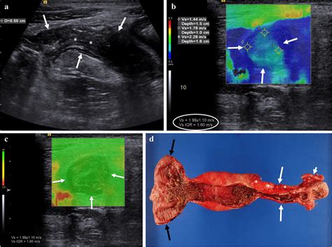 An 18-year-old man with stricturing Crohn disease affecting the ...