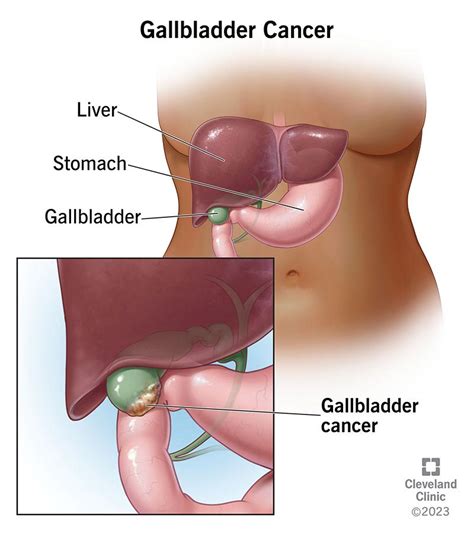 Signs And Symptoms Of Gallbladder Cancer - Ask The Nurse Expert