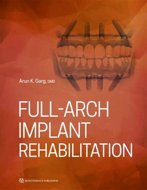 Full-Arch Implant Rehabilitation | DocMode Health Technologies Limited