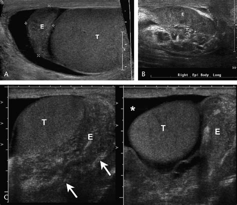 Epididymitis Ultrasound