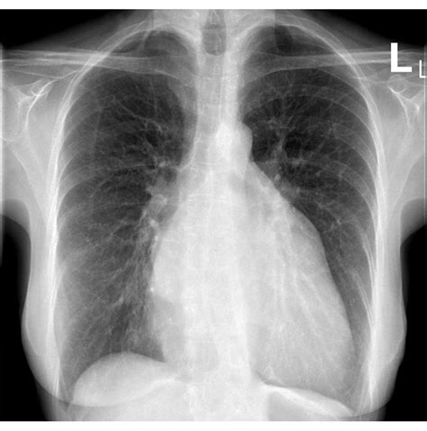 Systemic lupus erythematosus x ray - wikidoc