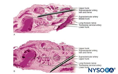 Complications and Prevention of Neurologic Injury with Peripheral Nerve ...