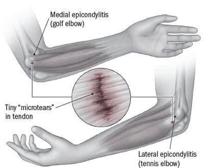 Tennis elbow (lateral epicondylitis) Guide: Causes, Symptoms and Treatment Options