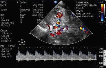 Transcranial doppler ultrasound in neurocritical care | Radiology Key