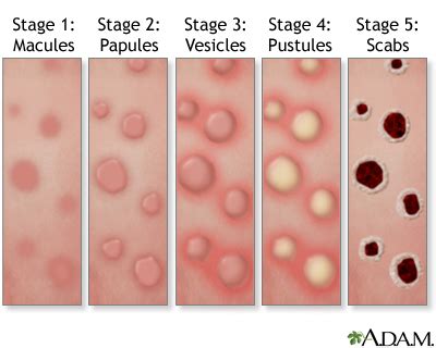 Mpox rash: MedlinePlus Medical Encyclopedia Image