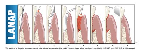 Laser-Assisted New Attachment Procedure (LANAP) FAQs