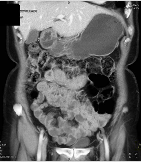 Normal CT Enteroclysis Study - Gastrointestinal Case Studies - CTisus ...