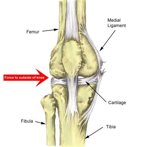 Medial Knee Ligament (MCL Sprain) - Symptoms, Treatment & Exercises