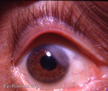 Sclerosing keratitis. EyeRounds.org: Online Ophthalmic Atlas