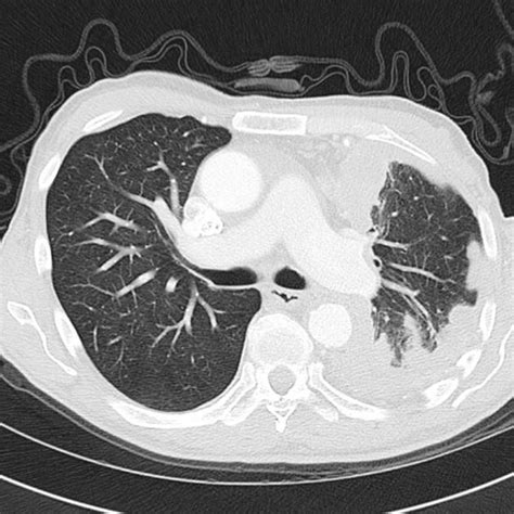 Mesothelioma | Radiology Case | Radiopaedia.org | Mesothelioma, Radiology, Case