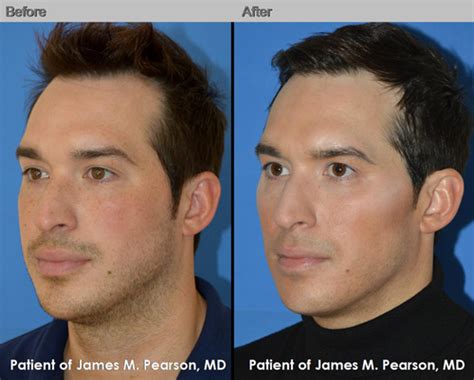 Cheek Enhancement Photo - Dr. James Pearson Facial Plastic Surgery