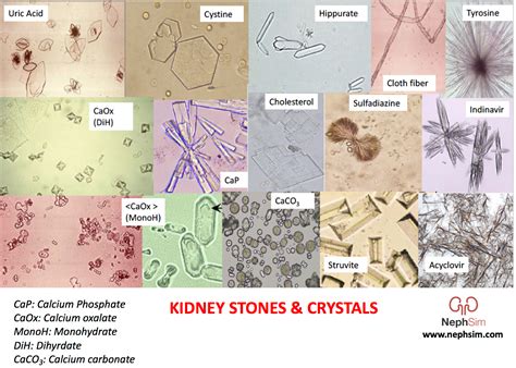 Calcium Oxalate Kidney Stones Microscope