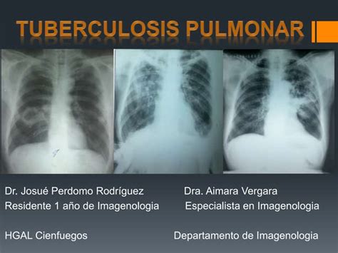 Tuberculosis Pulmonar diagóstico Imagenológico | PPT