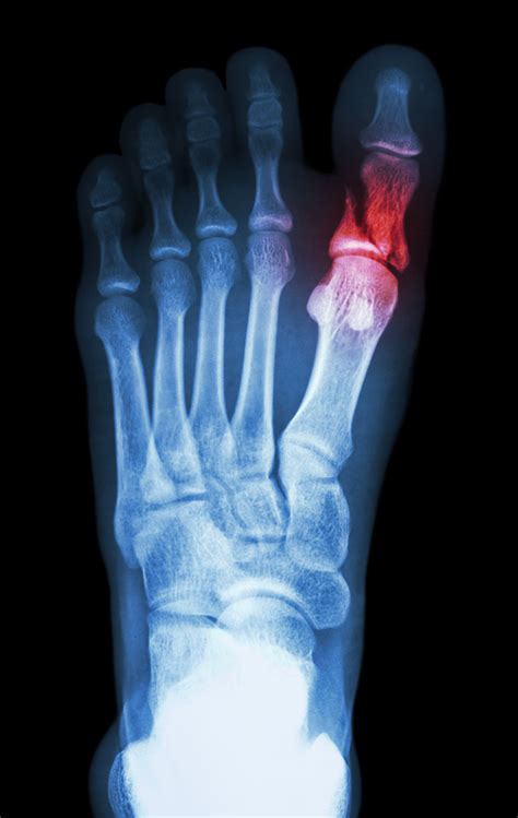 Common Symptoms and Treatment of a Fractured Toe