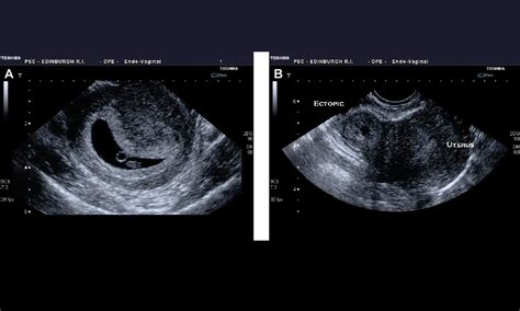 Demographic, lifestyle, and reproductive risk factors for ectopic pregnancy