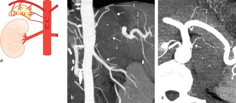 Suprarenal Arteries | Radiology Key