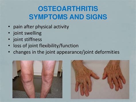 Osteoarthritis Treatment Alternatives