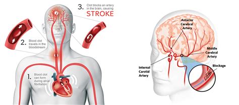 Acute Ischemic Stroke | Varicose veins | Vascular surgeon | Stroke ...