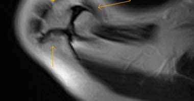 Os Acromiale with Impingement-MRI - Sumer's Radiology Blog