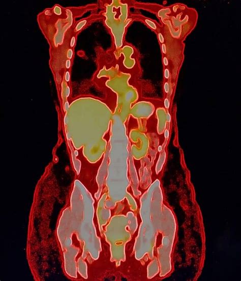 Research Points to Value for Fourth Follow-Up PET/CT Scans for Lung ...