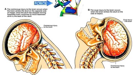 Closed-head injury