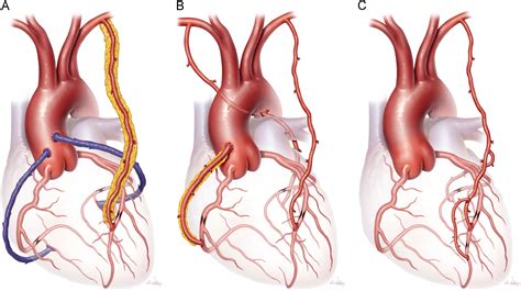 Conduits in Coronary Artery Bypass Grafting - Seminars in Thoracic and Cardiovascular Surgery