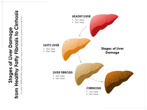 Stages Of Liver Damage From Healthy Fatty Fibrosis To Cirrhosis ...