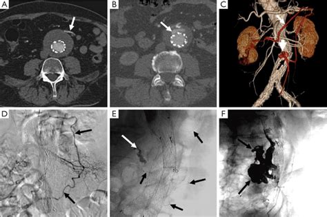 Treatment of a type II endoleak. Axial contrast-enhanced post-EVAR ...