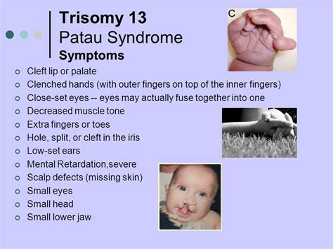 Pin by nonas arc on Trisomy 13 aka Patau Syndrome | Patau syndrome ...