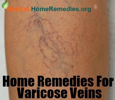 Varicose veins Home Remedies | Good stuff to know | Pinterest