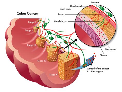 staging of colon cancer