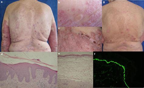 Clinical, histological and immunofluorescent findings in patient 1:... | Download Scientific Diagram