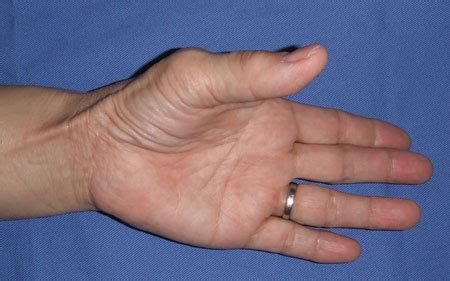 More than half of patients regain thumb opposition after carpal tunnel release