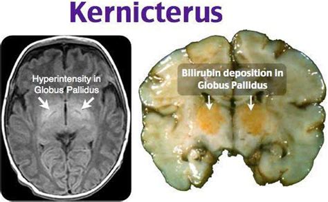 Kernicterus - MEDizzy