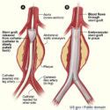 ABOUT ENDOVASCULAR REPAIR WITH A STENT GRAFT