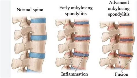 Ankylosing Spondylitis - Plants Cures