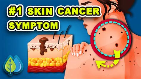 Skin Cancer Symptoms: #1 Symptom People Ignore