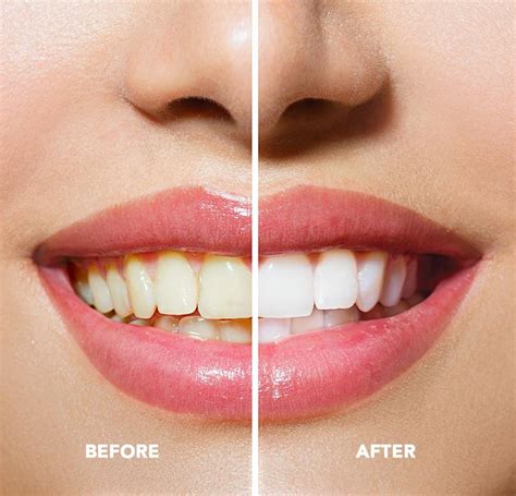 What is Cosmetic Teeth Whitening? | Advancingmbcpatientcare