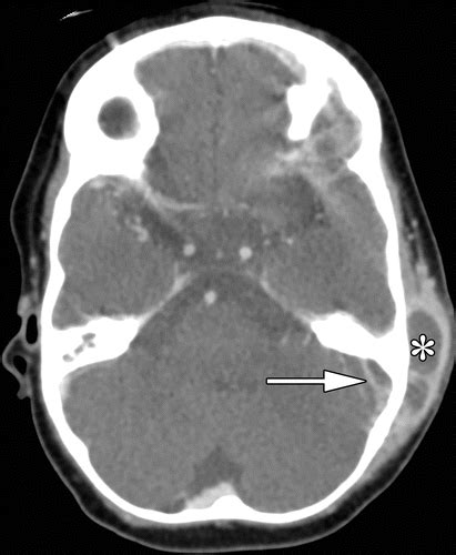 Superior Sagittal Sinus Thrombosis