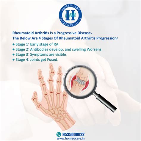 4 Stages of Rheumatoid Arthritis Progression | Homeocare International ...