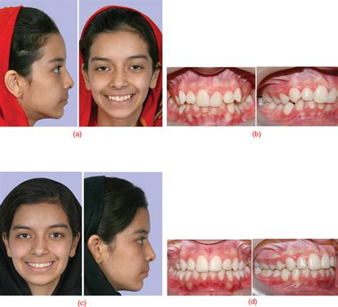 Class 2 Occlusion