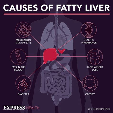 Fatty liver disease: Warning signs alcohol has caused 'irreversible' damage | Express.co.uk